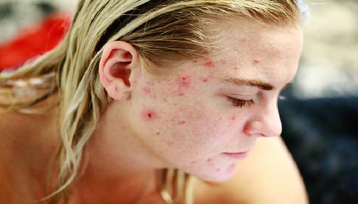 The result of the image for How does acne combat Azelaic Acid?