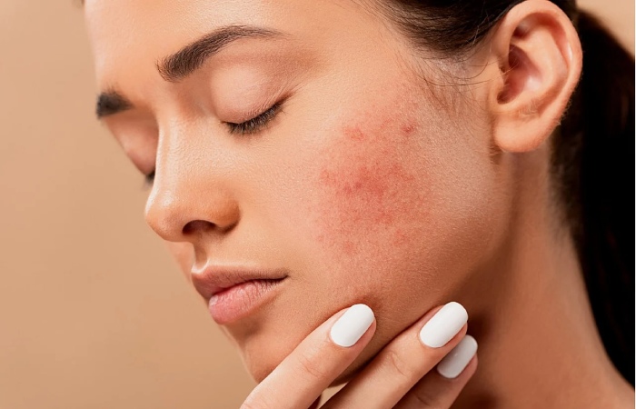 Control acne - CBD for physical health