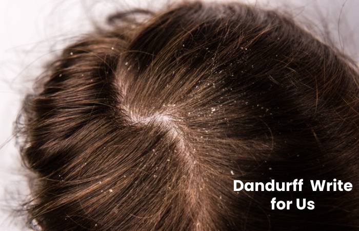 Dandruff Write for Us