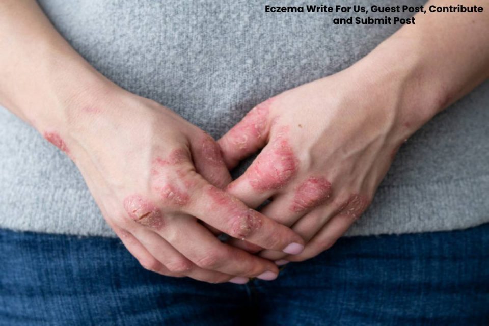 Eczema Write For Us, Guest Post, Contribute and Submit Post