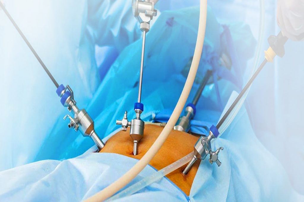 Laparoscopy
