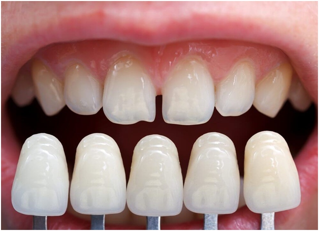 Dental veneers