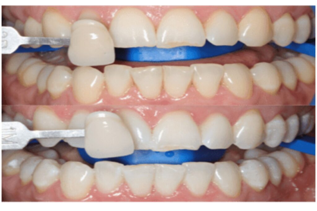 Sensitive teeth