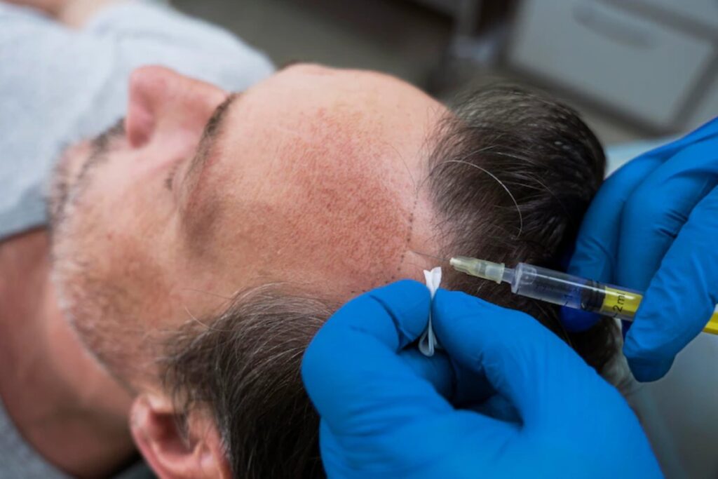 Hair transplant