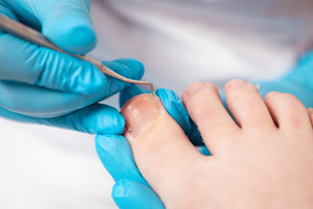 Ingrown Toenails