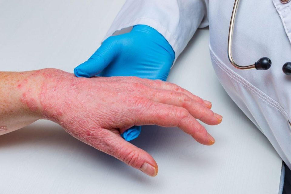 Skin allergies