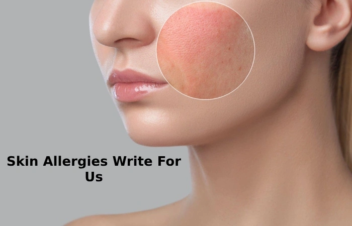 Skin Allergies Write for Us