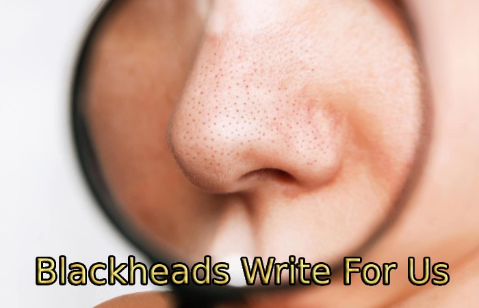 Blackheads Write For Us